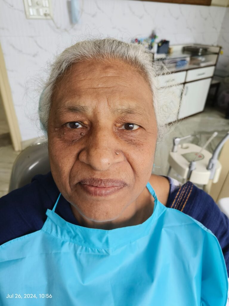 Full Mouth Rehabilitation in paschim vihar